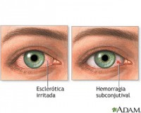 /album/fotogaleria/ojos-irritados-jpg/
